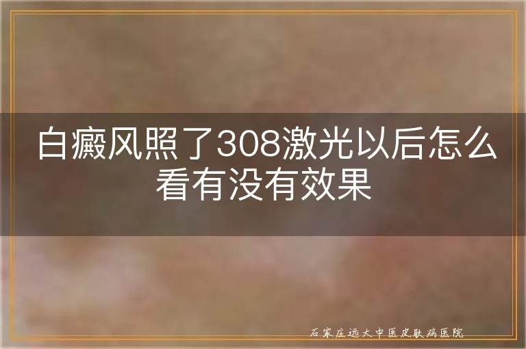 白癜风照了308激光以后怎么看有没有效果