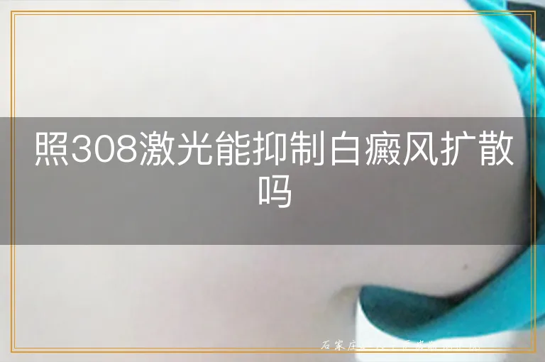 照308激光能抑制白癜风扩散吗