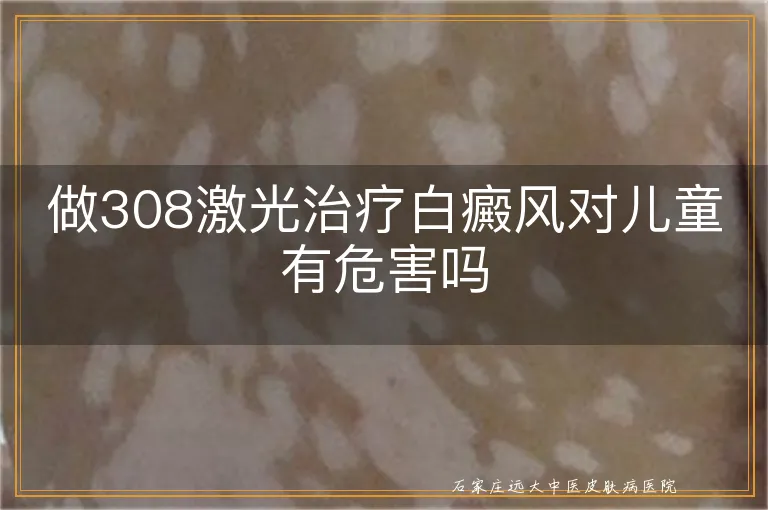 做308激光治疗白癜风对儿童有危害吗