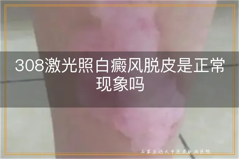 308激光照白癜风脱皮是正常现象吗