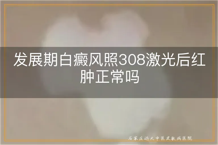 发展期白癜风照308激光后红肿正常吗