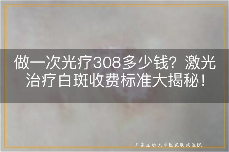 做一次光疗308多少钱？激光治疗白斑收费标准大揭秘！