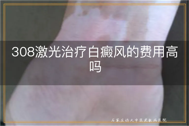 308激光治疗白癜风的费用高吗