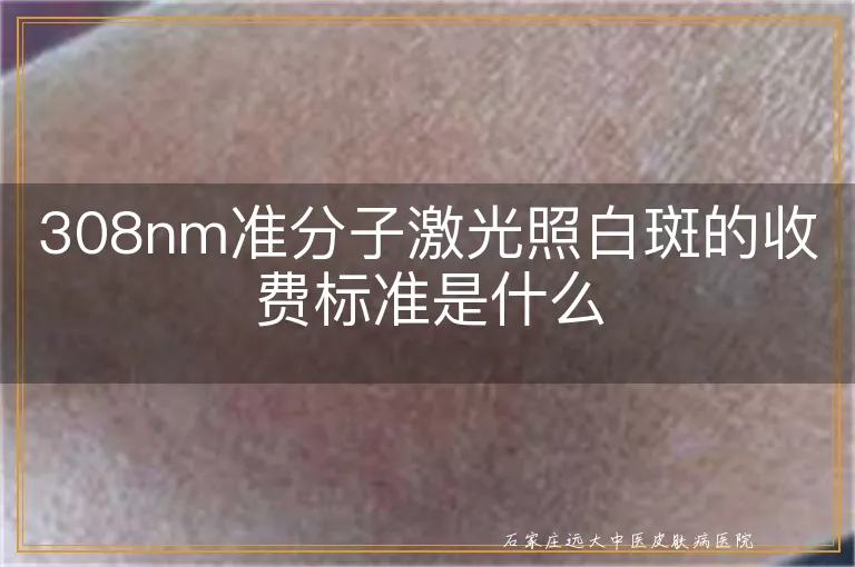 308nm准分子激光照白斑的收费标准是什么