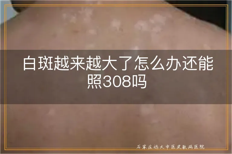 白斑越来越大了怎么办还能照308吗