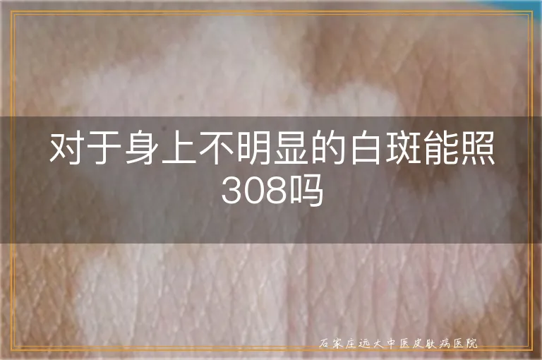 对于身上不明显的白斑能照308吗