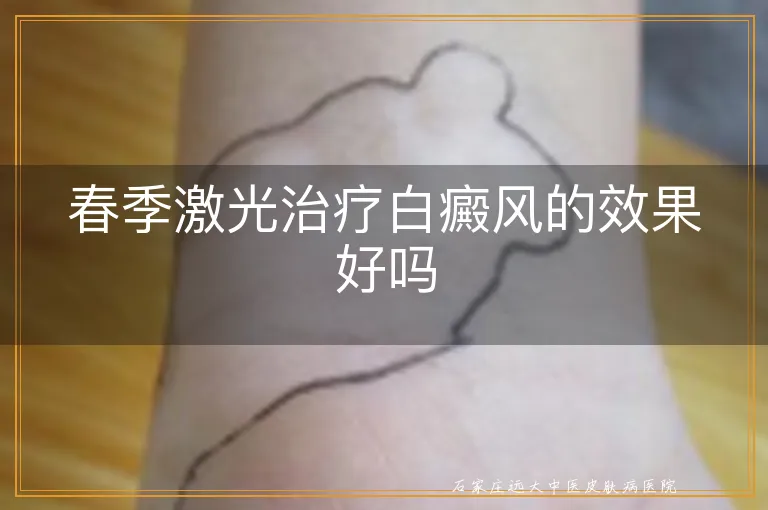 春季激光治疗白癜风的效果好吗