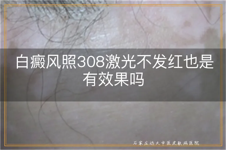 白癜风照308激光不发红也是有效果吗