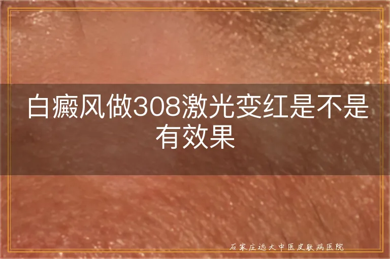 白癜风做308激光变红是不是有效果