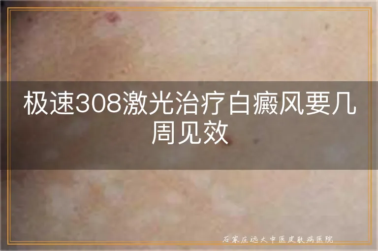 极速308激光治疗白癜风要几周见效