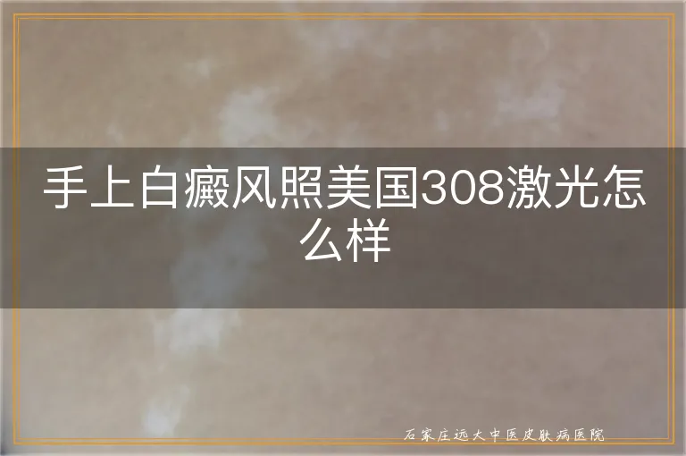 手上白癜风照美国308激光怎么样