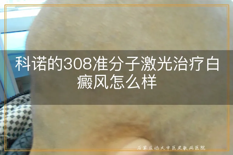 科诺的308准分子激光治疗白癜风怎么样