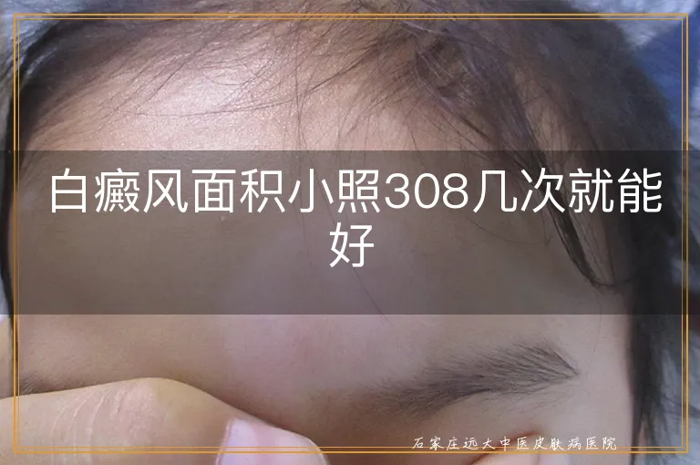 白癜风面积小照308几次就能好