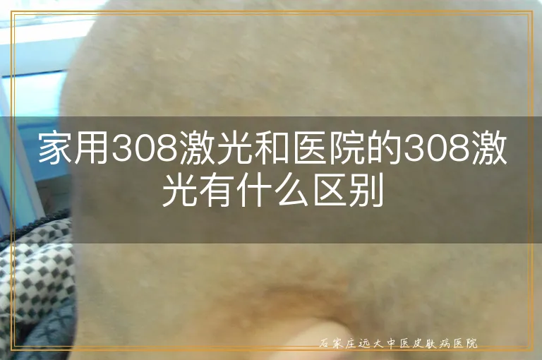 家用308激光和医院的308激光有什么区别