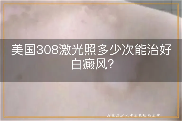 美国308激光照多少次能治好白癜风？