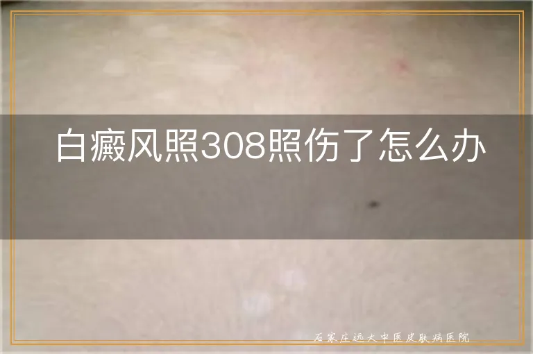 白癜风照308照伤了怎么办