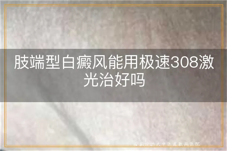 肢端型白癜风能用极速308激光治好吗