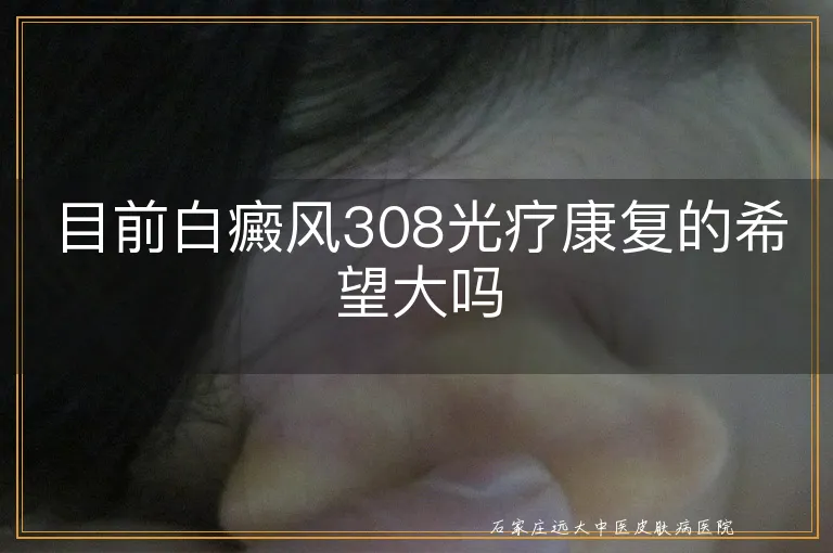 目前白癜风308光疗康复的希望大吗