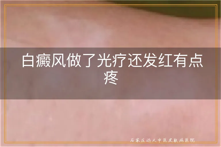 白癜风做了光疗还发红有点疼