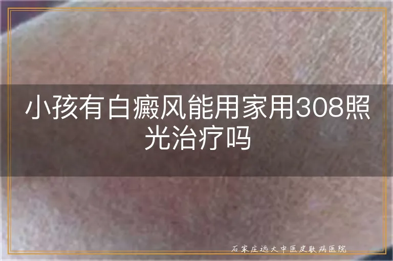 小孩有白癜风能用家用308照光治疗吗