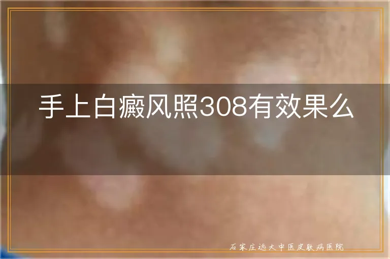 手上白癜风照308有效果么