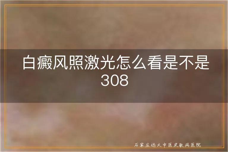 白癜风照激光怎么看是不是308