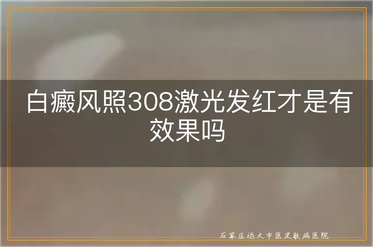 白癜风照308激光发红才是有效果吗