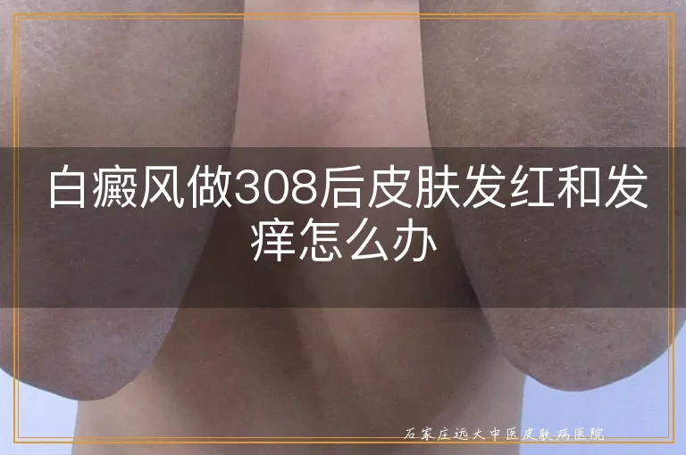 白癜风做308后皮肤发红和发痒怎么办