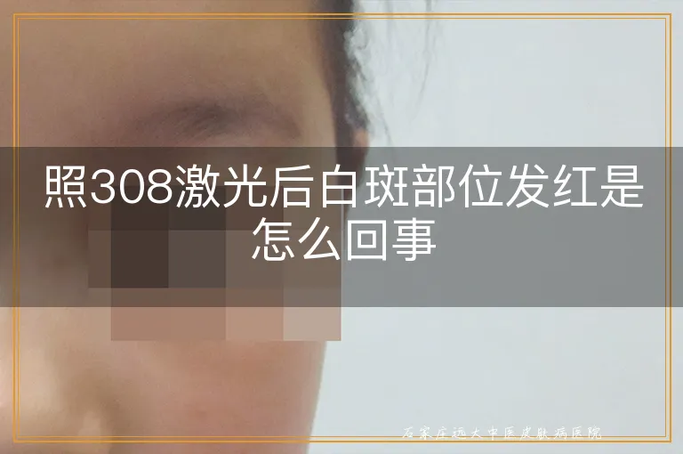 照308激光后白斑部位发红是怎么回事