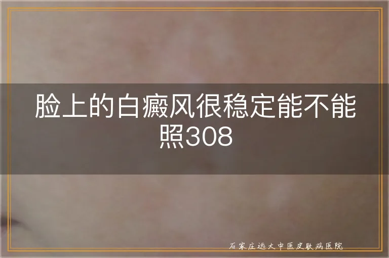 脸上的白癜风很稳定能不能照308