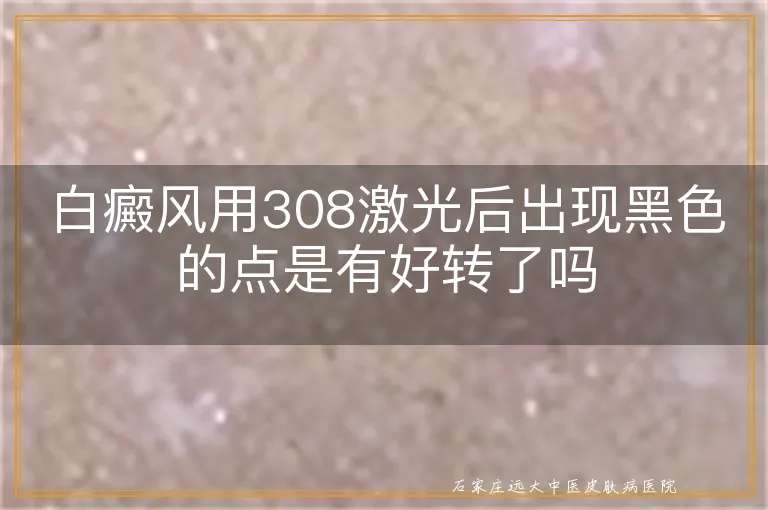 白癜风用308激光后出现黑色的点是有好转了吗