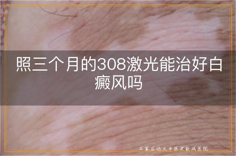 照三个月的308激光能治好白癜风吗