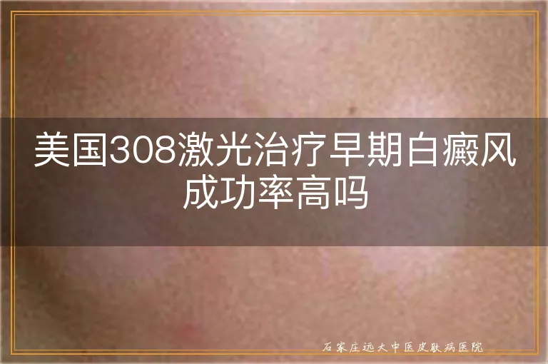 美国308激光治疗早期白癜风成功率高吗