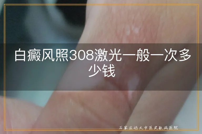 白癜风照308激光一般一次多少钱