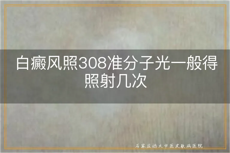 白癜风照308准分子光一般得照射几次