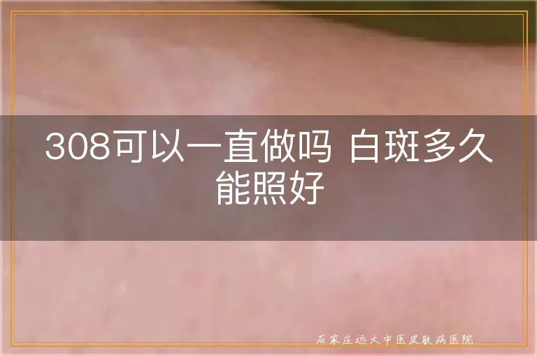 308可以一直做吗 白斑多久能照好