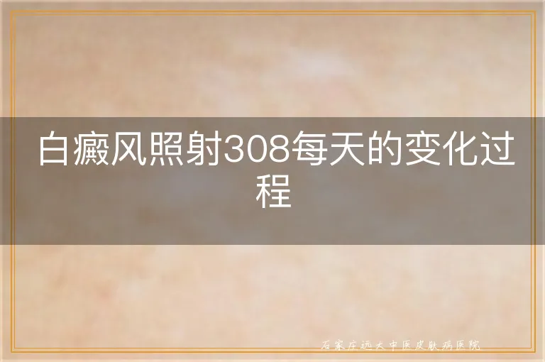 白癜风照射308每天的变化过程