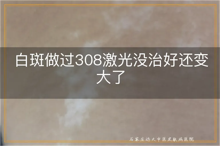 白斑做过308激光没治好还变大了