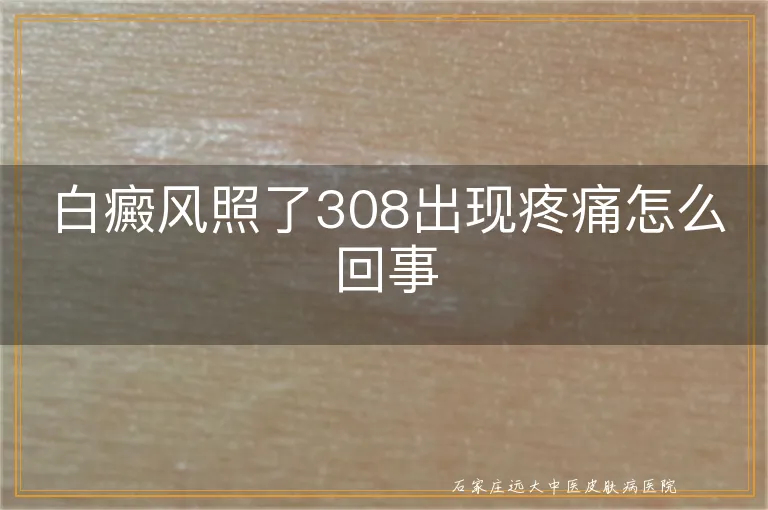 白癜风照了308出现疼痛怎么回事