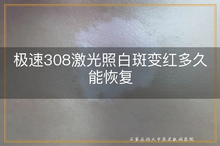 极速308激光照白斑变红多久能恢复