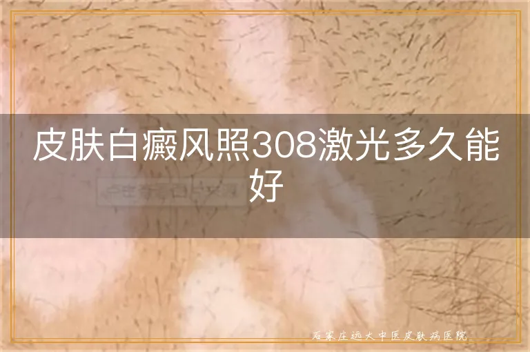 皮肤白癜风照308激光多久能好