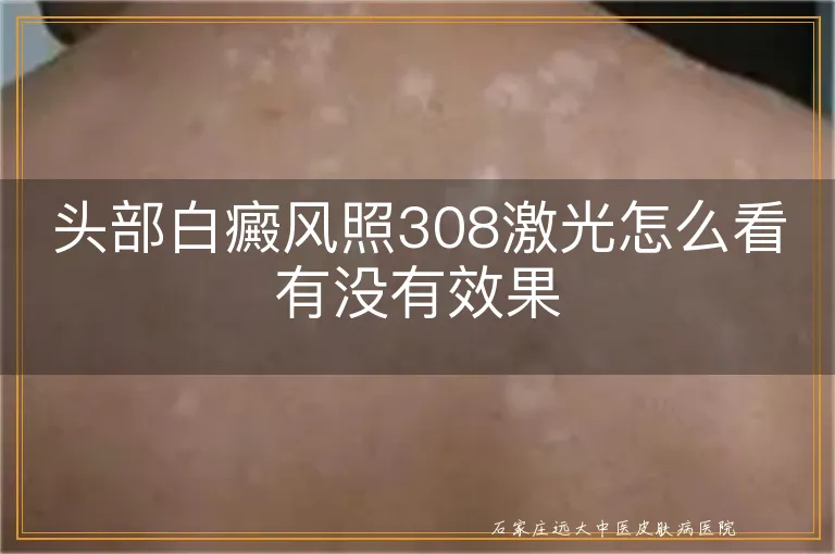 头部白癜风照308激光怎么看有没有效果