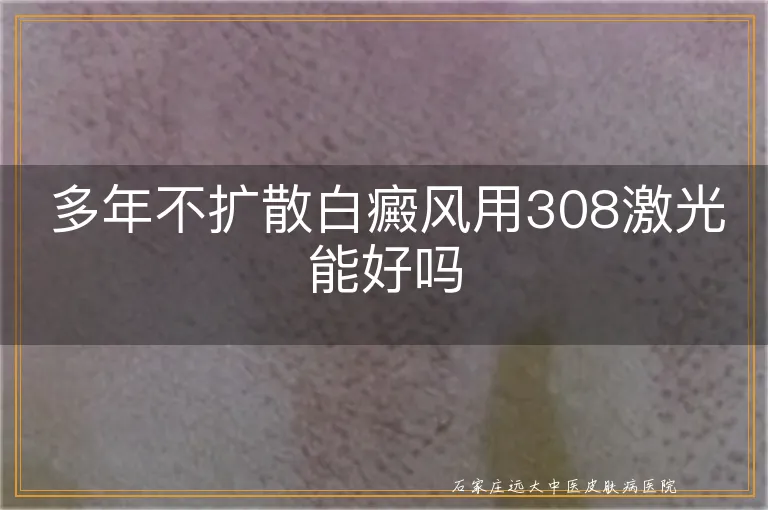 多年不扩散白癜风用308激光能好吗