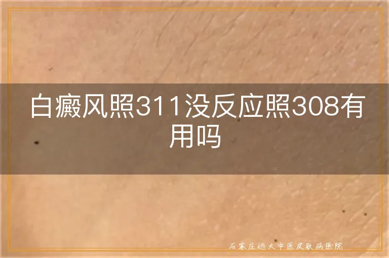 白癜风照311没反应照308有用吗