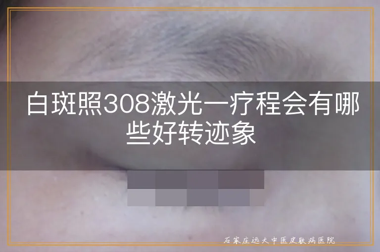 白斑照308激光一疗程会有哪些好转迹象