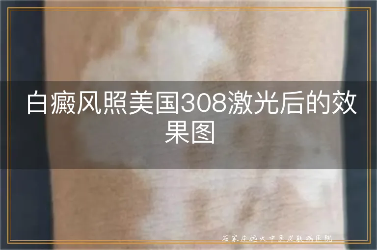 白癜风照美国308激光后的效果图