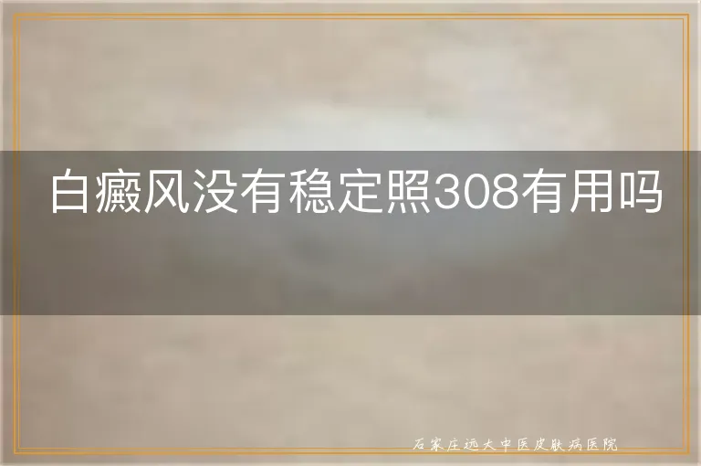 白癜风没有稳定照308有用吗