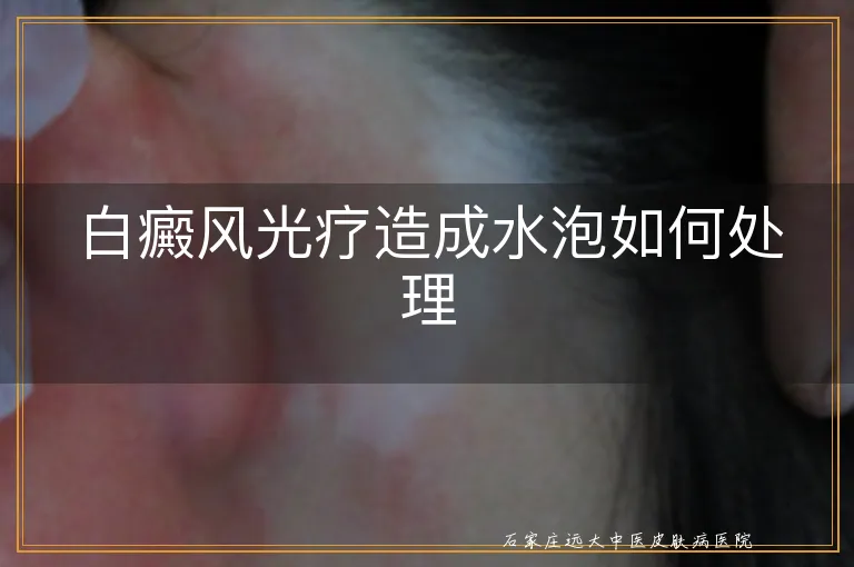 白癜风光疗造成水泡如何处理