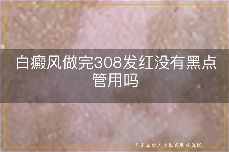 白癜风做完308发红没有黑点管用吗