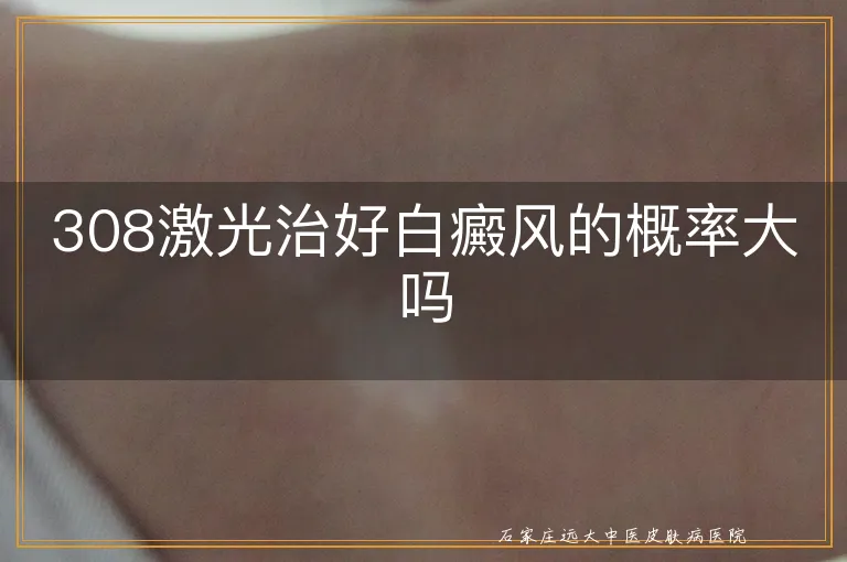 308激光治好白癜风的概率大吗